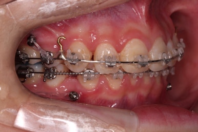 연산동치아교정