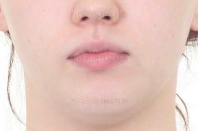 부산비대칭교정