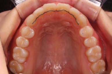 부산나비앞니교정