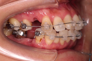 동래임플란트교정