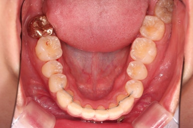 부산앞니부분교정