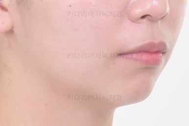 부산사랑니교정