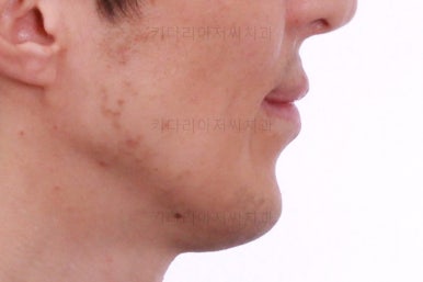 부산구순구개열교정