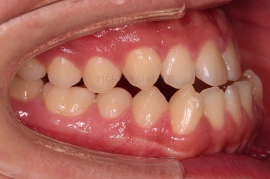 부산주걱턱교정