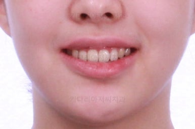 부산투명교정