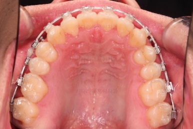 부산긴얼굴긴턱교정