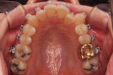 부산치아교정잘하는곳