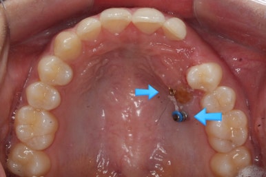 부산매복치아교정