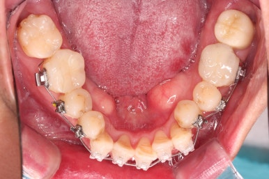 부산구순구개열교정