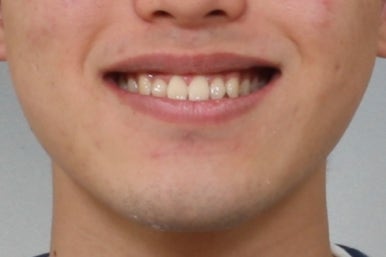 부산주걱턱교정