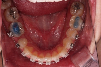 연산동치아교정