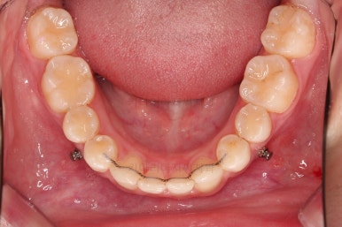 연산동치아교정