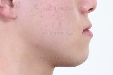 부산주걱턱교정