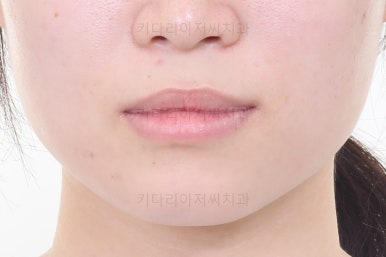 부산치아교정추천