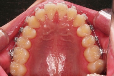 부산주걱턱교정