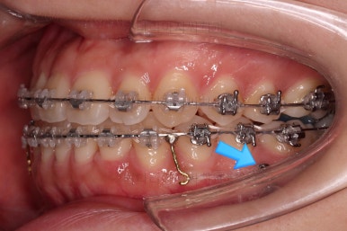 부산치아교정추천