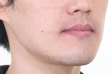 부산비수술교정