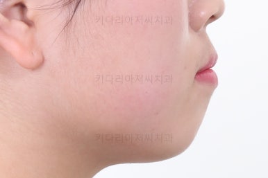 부산비발치교정