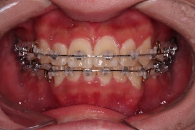 부산돌출입교정