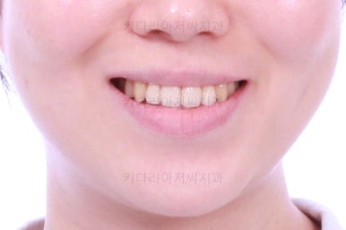 부산치아교정잘하는곳