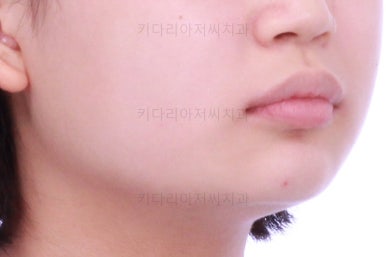 부산어린이치아교정