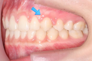부산매복치아교정