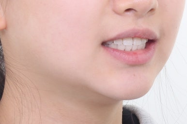 부산치아교정잘하는곳