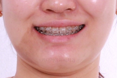 부산치아교정잘하는곳