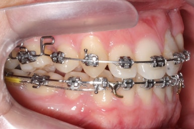 부산구순구개열