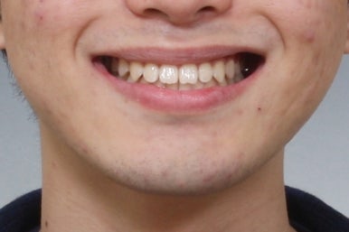 부산주걱턱교정