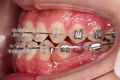 부산주걱턱교정