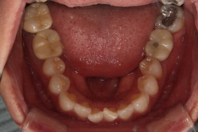 부산부분치아교정