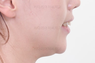 부산비대칭교정