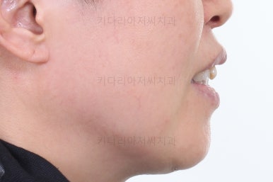 동래임플란트교정