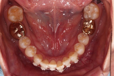 부산치아교정비용