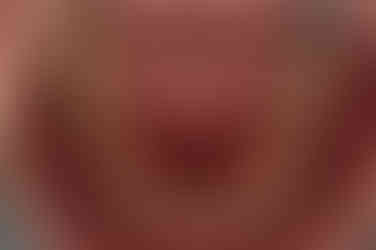 부산부분치아교정