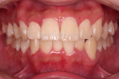 부산돌출입교정