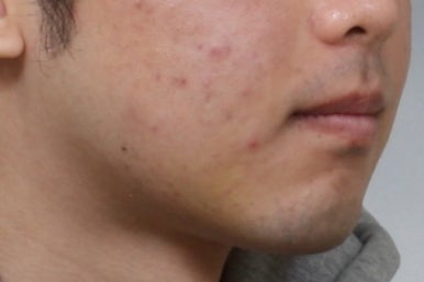 부산주걱턱교정