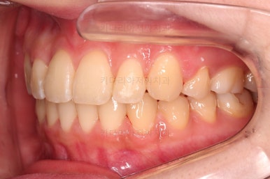 부산돌출입교정