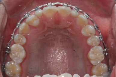 부산왜소치교정