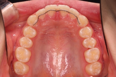 부산앞니벌어짐교정