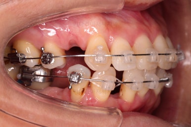 동래임플란트교정