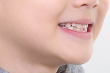 부산어린이치아교정