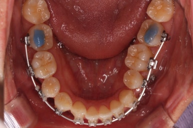 부산비수술교정