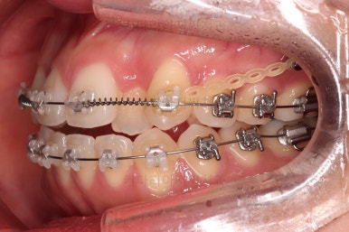 부산비발치교정