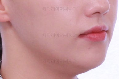 부산비대칭교정