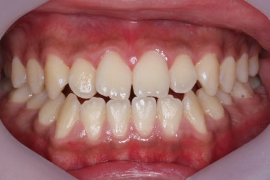 부산주걱턱교정