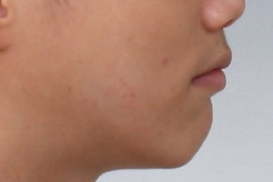 부산왜소치교정