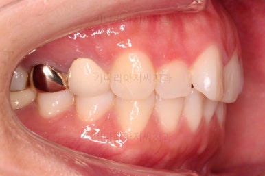 부산부분치아교정