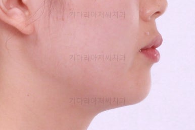 부산앞니부분교정